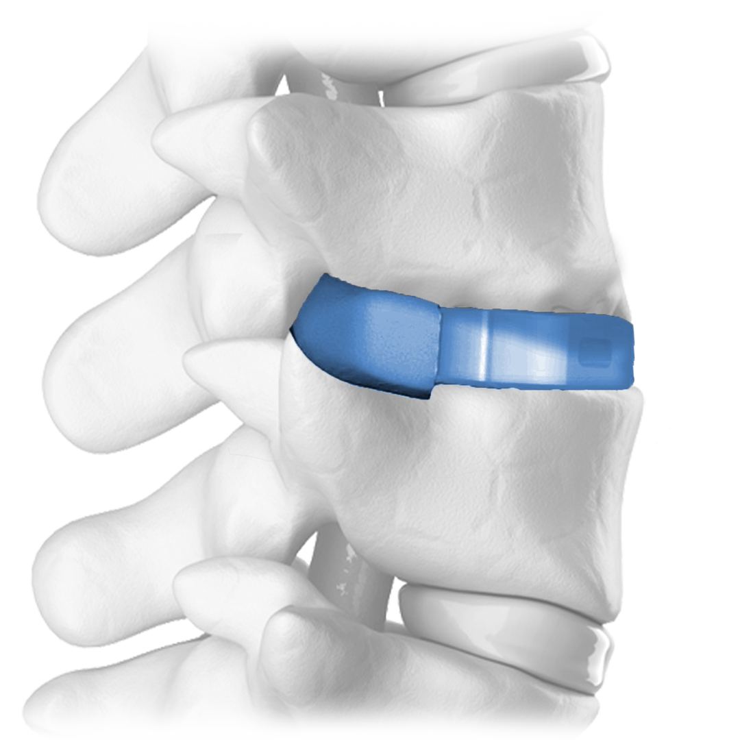 Spine-1 Spine-1