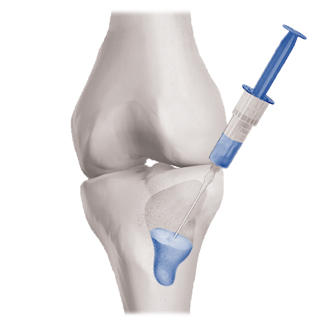 bone void filler bone void filler